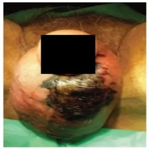 Zgorzel fourniera choroba moszny