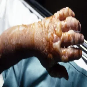 Zgorzel gazowa na dłoni