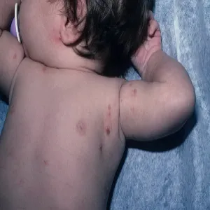 Zmiany skórne grudki choroba świerzb