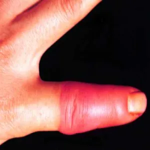 Zmiana skórna na palcu różyca 