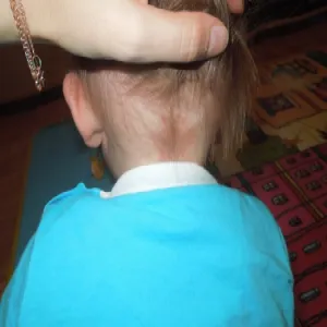 Zmiana skórna na szyi u dziecka uszczypnięcie bociana