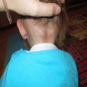 Zmiana skórna na szyi u dziecka uszczypnięcie bociana