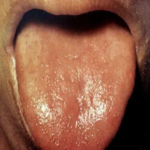 Zmiany na języku pelagra