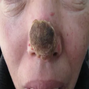 Zmiany na nosie  grzybica oportunistyczna mukormykoza