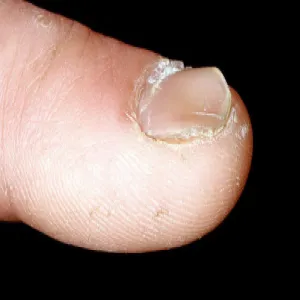 Zmiany na paznokciach koilonychia