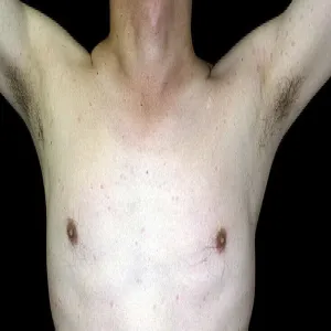 Zmiany na skórze u trenujących pokrzywka cholinergiczna 