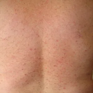 Zmiany skórne choroba Grovera