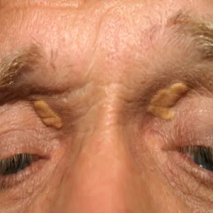 Zmiany skórne koło oczu kępki żółte 