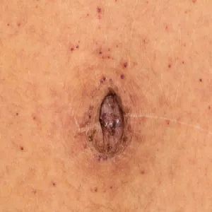 Zmiany skórne koło pępka choroba Fabry'ego