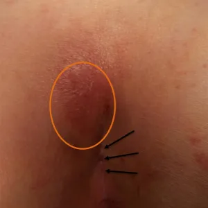 Zmiany skórne między pośladkami