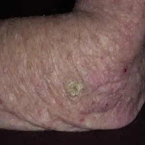 Zmiany skórne na łokciu rogowacenie słoneczne