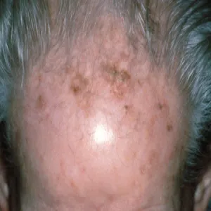 Zmiany skórne na czole