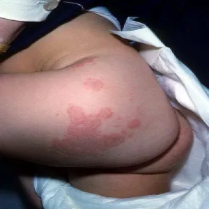 Zmiany skórne na pośladkach 