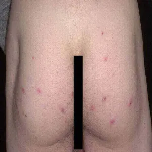 Zmiany skórne na pośladkach zapalenie mieszków włosowych