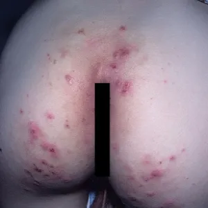 Zmiany skórne na pośladkach zdjęcia opryszczkowate zapalenie skóry