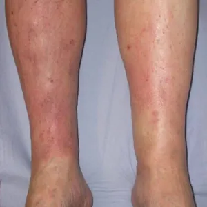  Zmiany skórne na podudziach wyprysk żylakowy