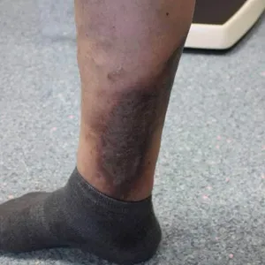 Zmiany skórne na podudziu wyprysk żylakowy