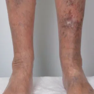 Zmiany skórne na podudziu wyprysk podudzi