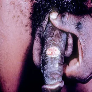 Zmiany skórne na prąciu ziarniniak pachwinowy 