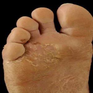 Zmiany skórne na stopach hiperkeratoza