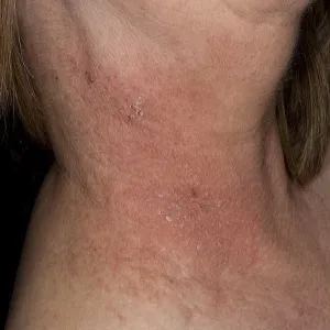 Zmiany skórne na szyi choroba Dariera