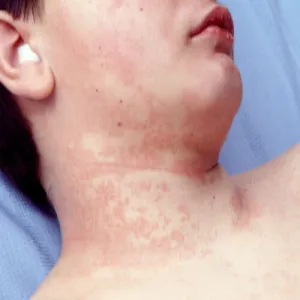 Zmiany skórne na szyi choroba Kawasakiego 