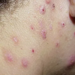 Zmiany skórne na tle nerwowym przeczosy