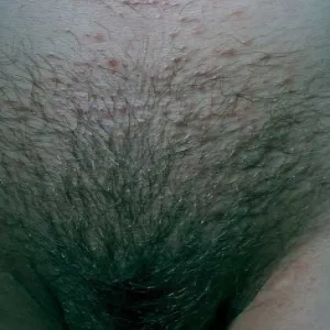 Zmiany skórne okolic intymnych choroba Foxa-Fordyce'a