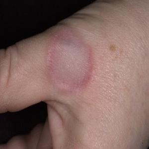Zmiany skórne palec kciuka ziarniniak obrączkowaty 
