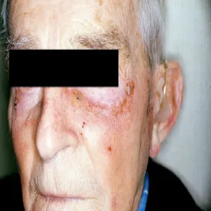 Zmiany skórne pod oczami rogowacenie słoneczne