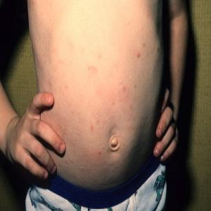 Zmiany skórne u dzieci na brzuchu choroba przyłuszczyca