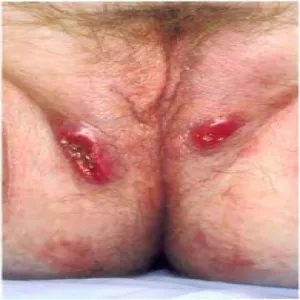 Zmiany skórne w okolicach intymnych u kobiet ziarniniak pachwinowy 