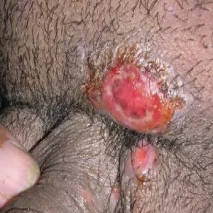 Zmiany skórne w okolicach intymnych u mężczyzn ziarniniak pachwinowy 