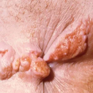 Zmiany skórne w okolicy odbytu ziarniniak pachwinowy 