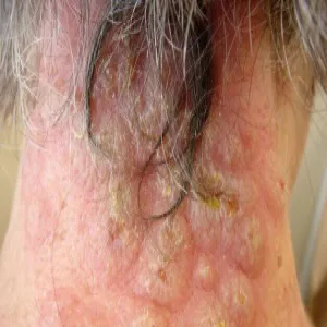 Zmiany skórne w zespole Sweeta na szyi