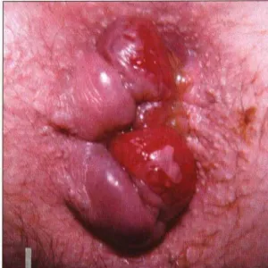 Zmiany w okolicy odbytu hemoroidy