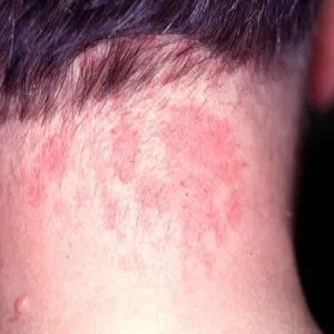 Znamię naczyniowe płaskie uszczypnięcie bociana