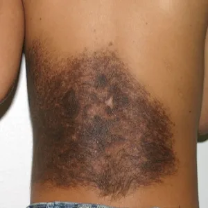 Znamiona barwnikowe płaskie