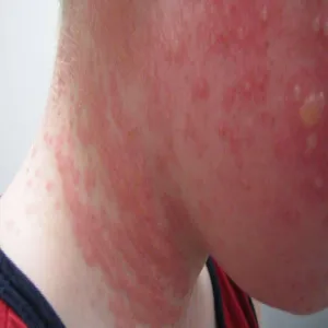 Alergia na słońce u dziecka na twarzy