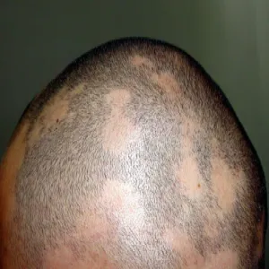 alopecia areata