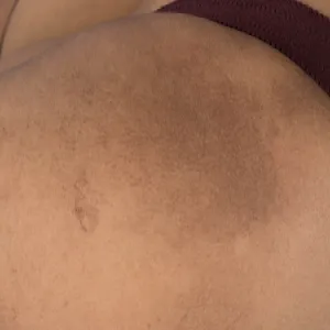 amyloidozy skóry na nodze