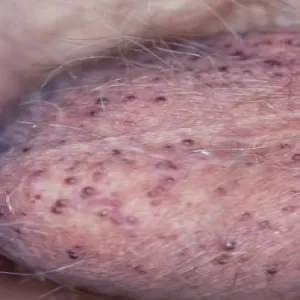 angiokeratoma na mosznie