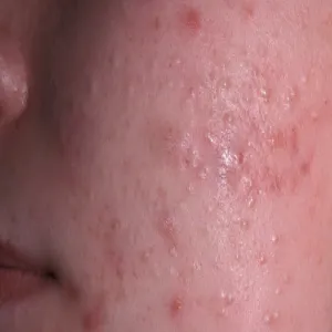 białe grudki na policzkach zaskórniki zamknięte