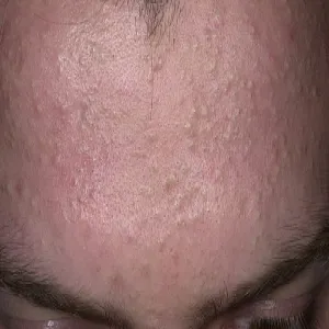 białe grudki pod skórą na czole zaskórniki zamknięte