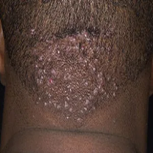 bliznowce trądzikowe zdjęcie