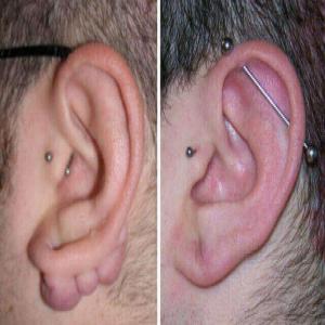 bliznowiec na uchu po kolczyku