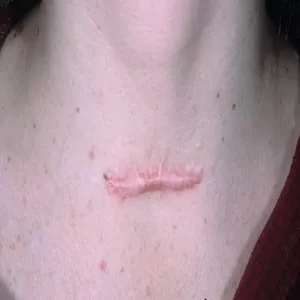 bliznowiec u kobiety