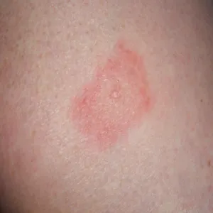 borelioza objawy skórne zdjęcia