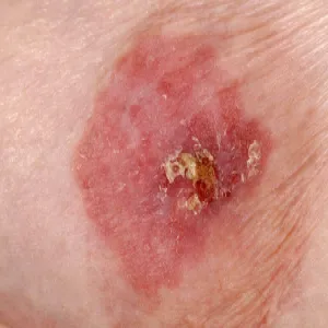 brodawka łuszcząca