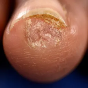 brodawka podpaznokciowa
